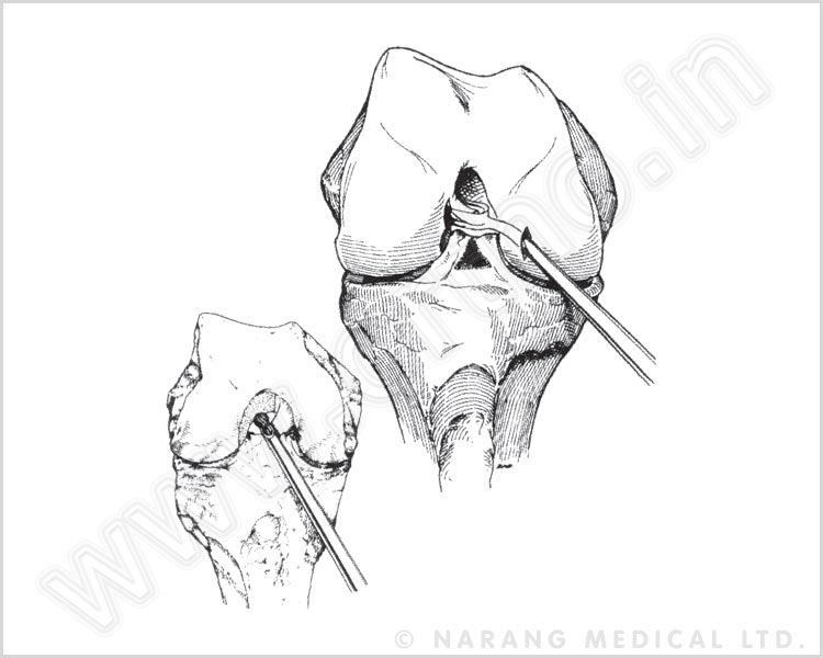 ACL/PCL Guide System