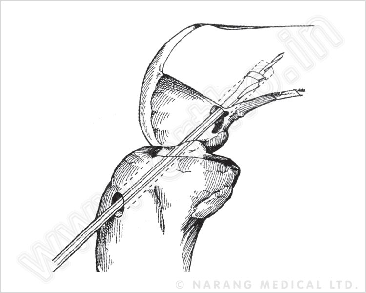 ACL/PCL Guide System