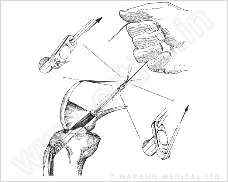 ACL/PCL Guide System