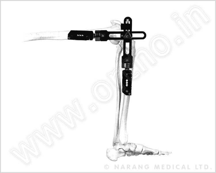 Knee Joint External Fixator