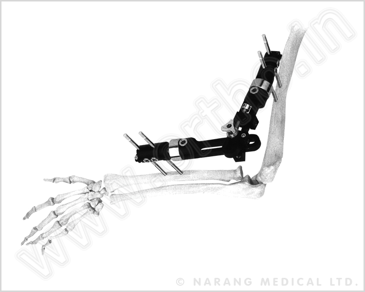 Elbow Joint External Fixator