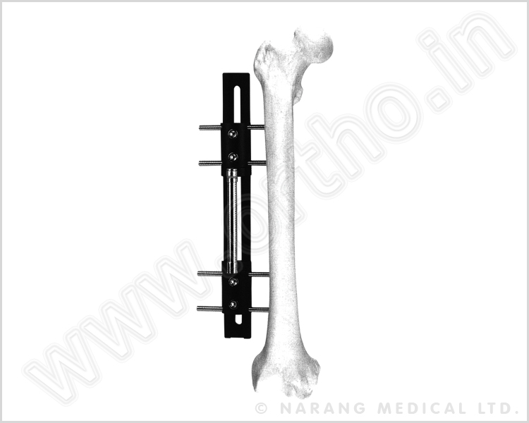 Bone Lengthening Fixators, Bone Lengthening Fixators Manufacturer, Bone ...