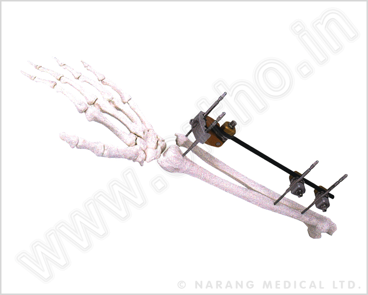 Q.5030    Ulna & Radius Fixator