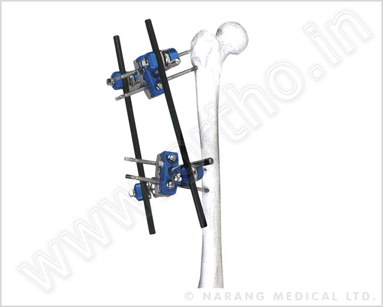 Q.5240    Proximal Femur Fixator