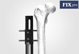 Bone Lengthening Fixators
