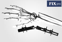 Dynamic Wrist & Forearm Fixators